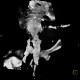 Rectovaginal fistula, VRT: CT - Computed tomography